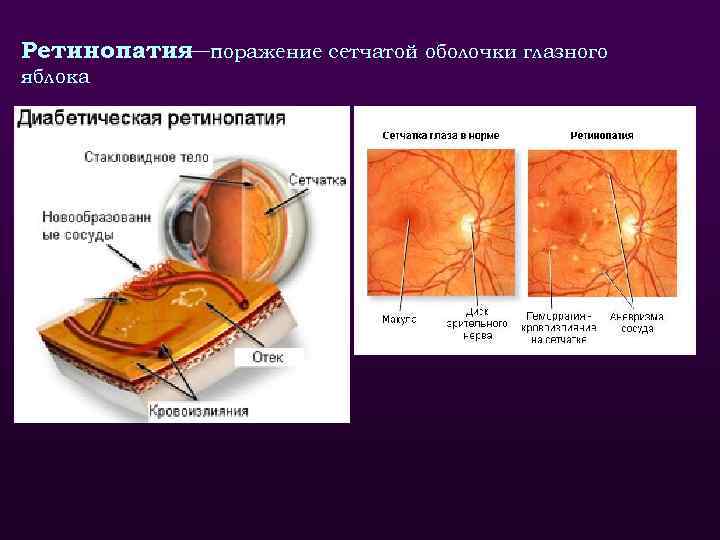 Ретинопатия поражение сетчатой оболочки глазного — яблока 