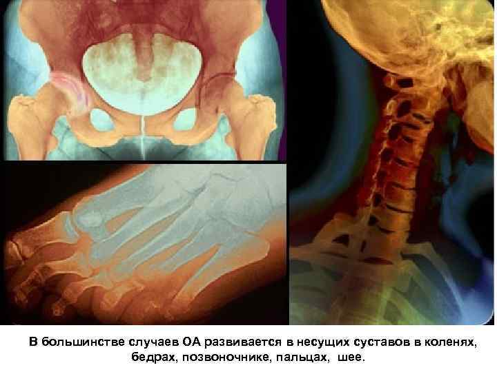  В большинстве случаев ОА развивается в несущих суставов в коленях, бедрах, позвоночнике, пальцах,