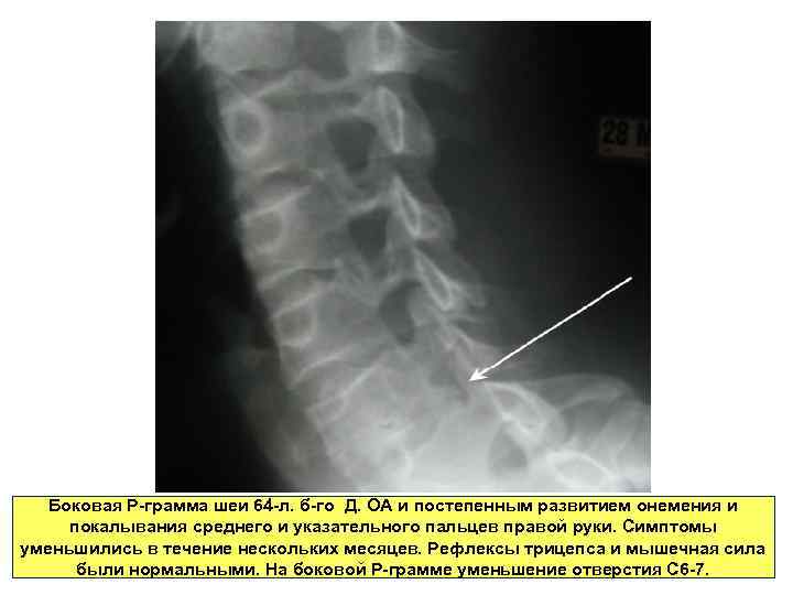 Боковая Р-грамма шеи 64 -л. б-го Д. ОА и постепенным развитием онемения и покалывания