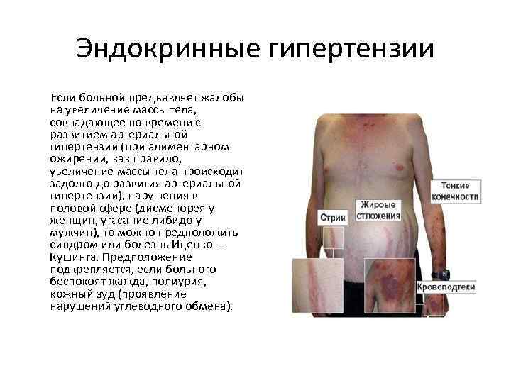 Эндокринные гипертензии Если больной предъявляет жалобы на увеличение массы тела, совпадающее по времени с