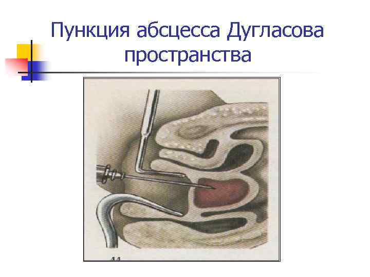 Пункция абсцесса Дугласова пространства 