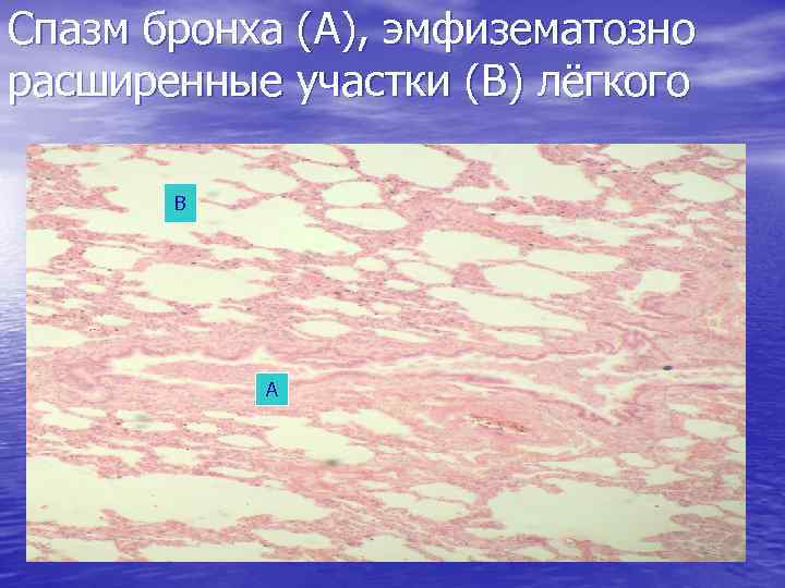 Спазм бронха (А), эмфизематозно расширенные участки (В) лёгкого В А 