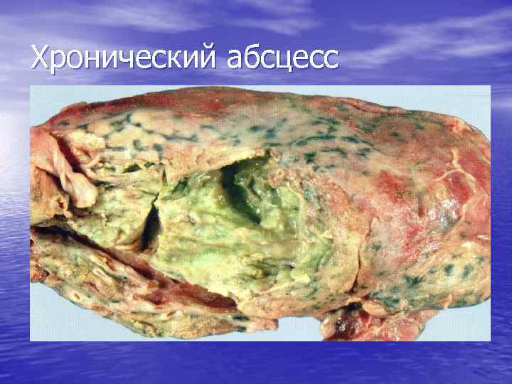 Хронический абсцесс 