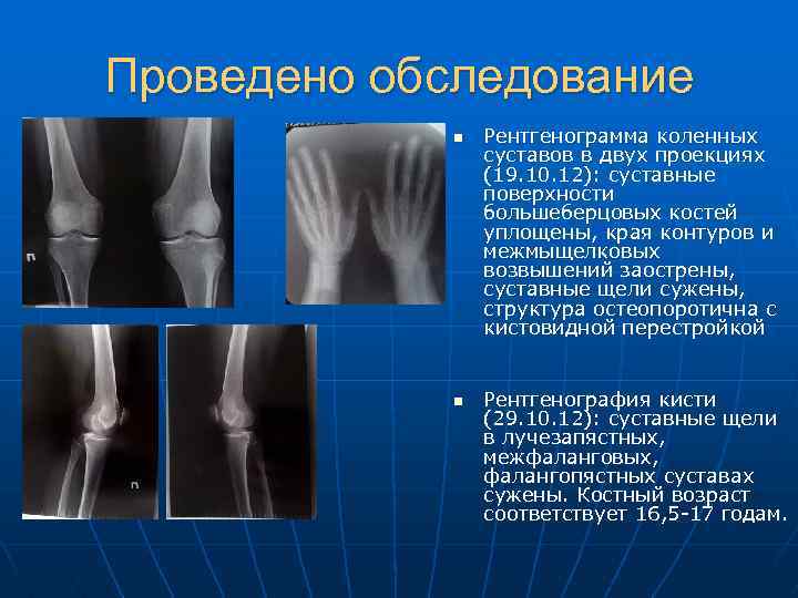 Проведено обследование n n Рентгенограмма коленных суставов в двух проекциях (19. 10. 12): суставные