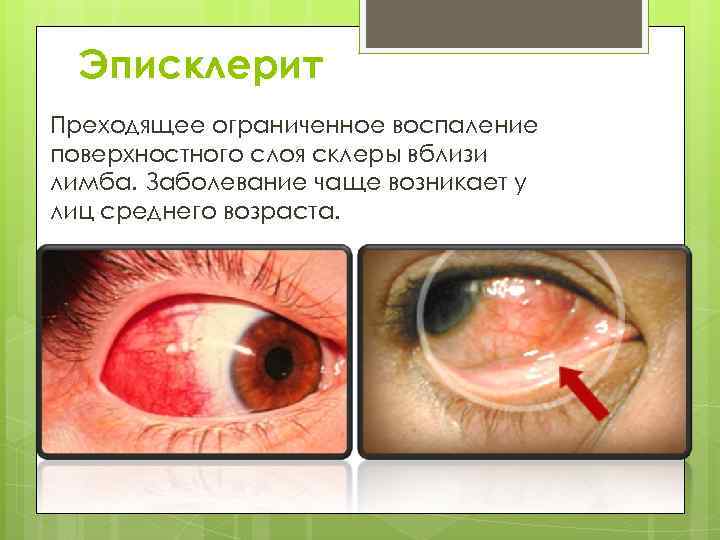 Эписклерит Преходящее ограниченное воспаление поверхностного слоя склеры вблизи лимба. Заболевание чаще возникает у лиц