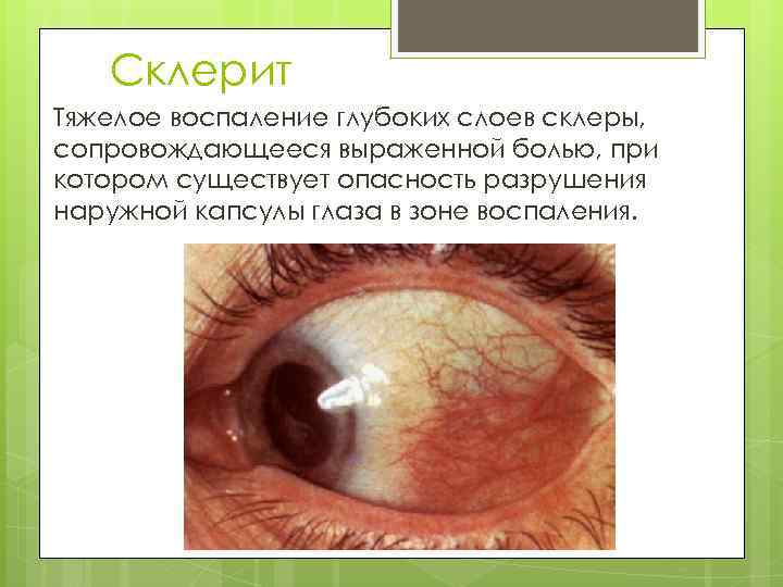 Склерит Тяжелое воспаление глубоких слоев склеры, сопровождающееся выраженной болью, при котором существует опасность разрушения