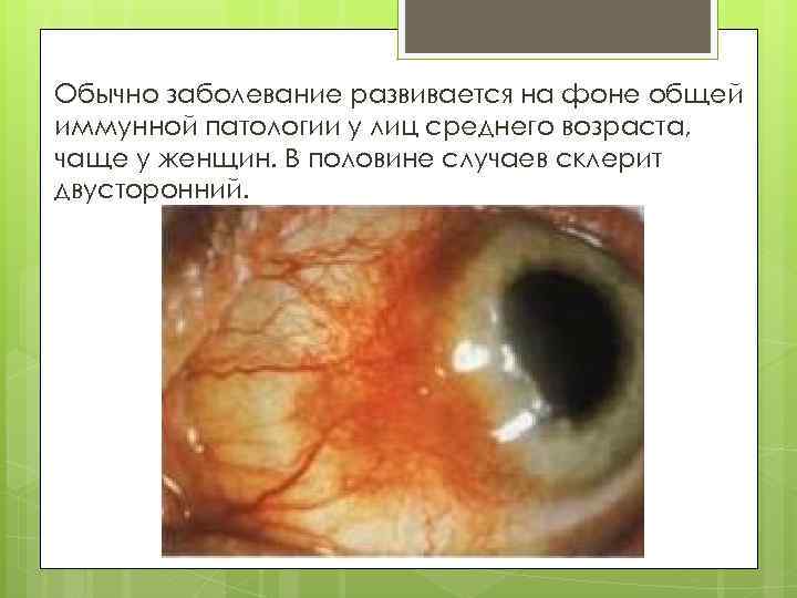 Обычно заболевание развивается на фоне общей иммунной патологии у лиц среднего возраста, чаще у