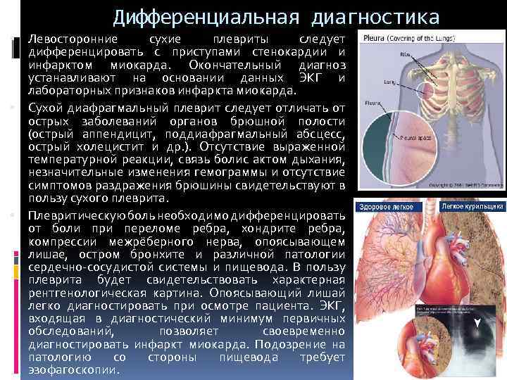Дифференциальная диагностика Левосторонние сухие плевриты следует дифференцировать с приступами стенокардии и инфарктом миокарда. Окончательный