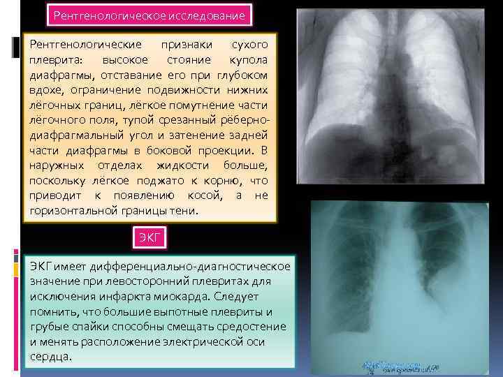 Рентгенологическое исследование Рентгенологические признаки сухого плеврита: высокое стояние купола диафрагмы, отставание его при глубоком