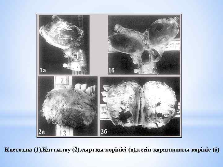 Кистозды (1), Қаттылау (2), сыртқы көрінісі (a), кесіп қарағандағы көрініс (б) 