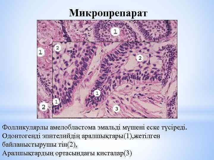 Микропрепарат Фолликулярлы амелобластома эмальді мүшені еске түсіреді. Одонтогенді эпителийдің аралшықтары(1), жетілген байланыстырушы тін(2), Аралшықтардың