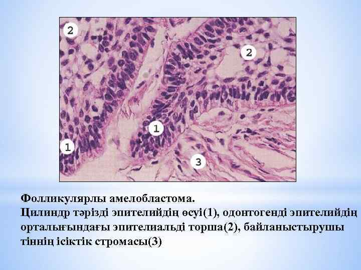 Фолликулярлы амелобластома. Цилиндр тәрізді эпителийдің өсуі(1), одонтогенді эпителийдің орталығындағы эпителиальді торша(2), байланыстырушы тіннің ісіктік