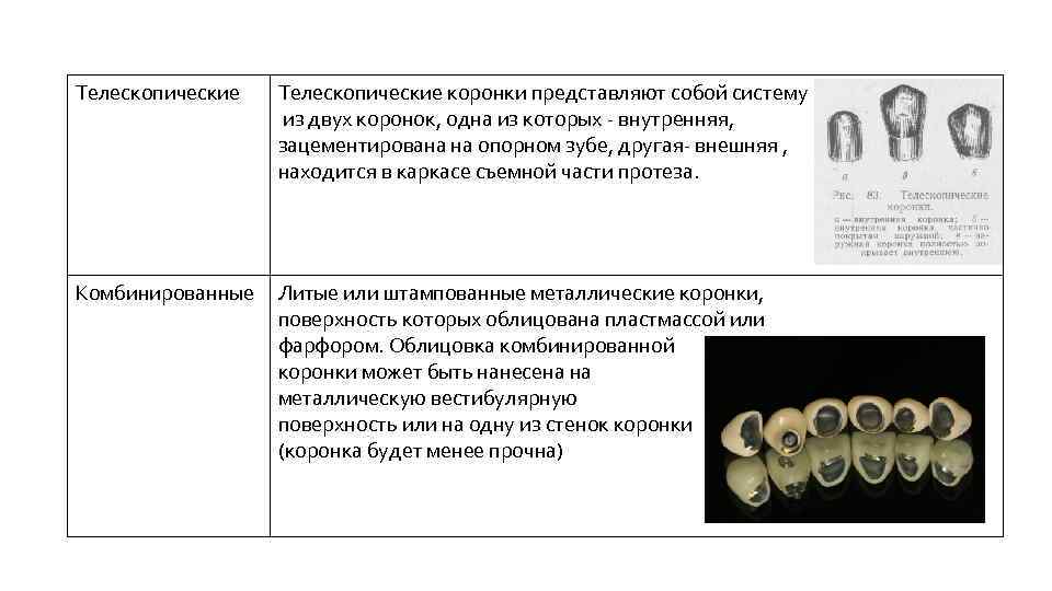 Телескопические коронки представляют собой систему из двух коронок, одна из которых - внутренняя, зацементирована