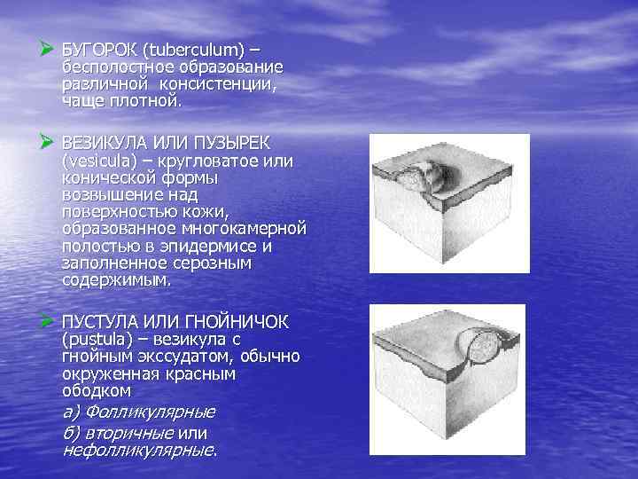 Ø БУГОРОК (tuberculum) – бесполостное образование различной консистенции, чаще плотной. Ø ВЕЗИКУЛА ИЛИ ПУЗЫРЕК