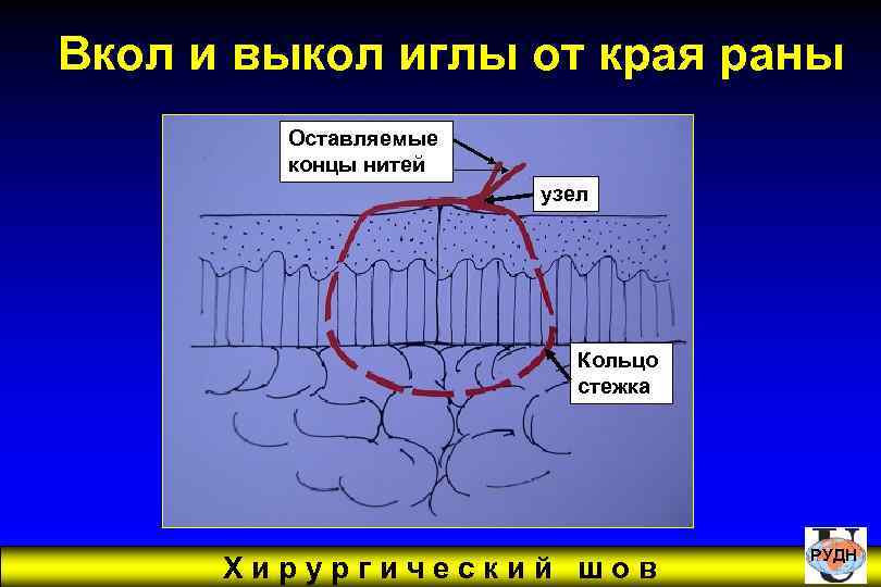 Вкол и выкол иглы от края раны Оставляемые концы нитей узел Кольцо стежка Хирургический