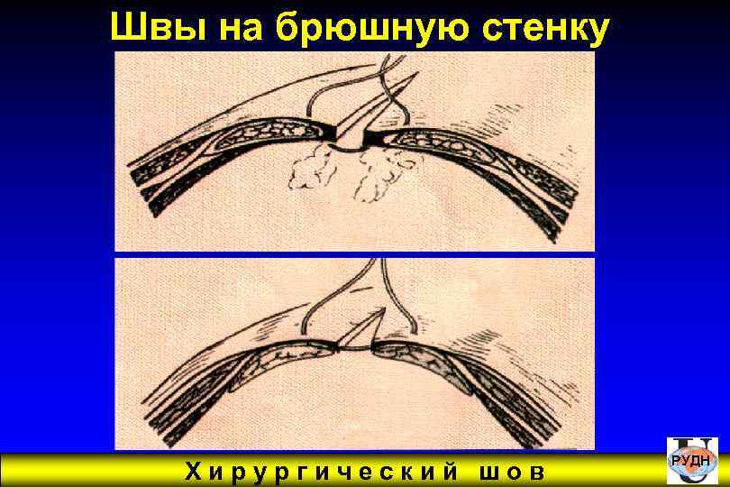 Швы на брюшную стенку Хирургический шов РУДН 