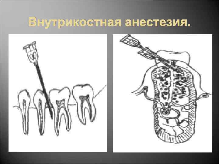 Внутрикостная анестезия. 