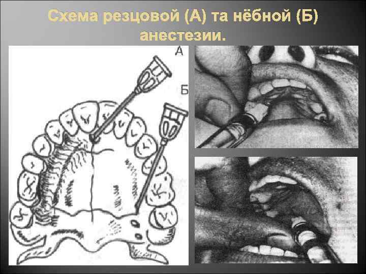 Схема резцовой (А) та нёбной (Б) анестезии. 