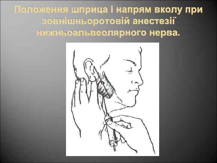 Положення шприца і напрям вколу при зовнішньоротовій анестезії нижньоальвеолярного нерва. 