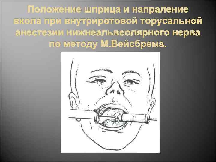 Положение шприца и напраление вкола при внутриротовой торусальной анестезии нижнеальвеолярного нерва по методу М.