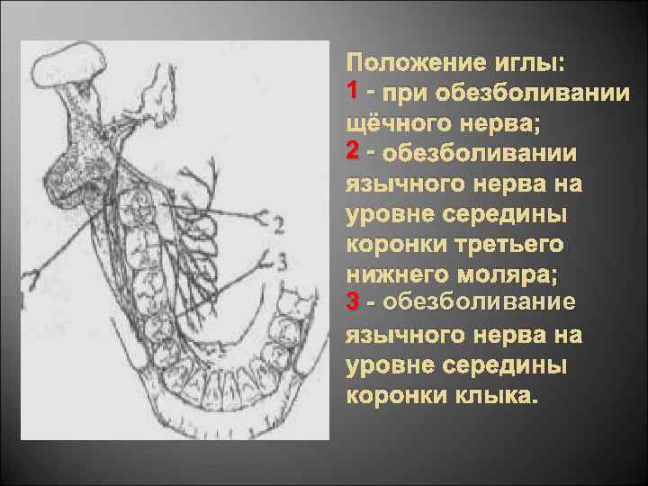 Положение иглы: 1 - при обезболивании щёчного нерва; 2 - обезболивании язычного нерва на