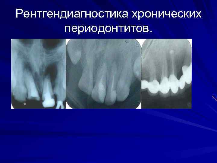 Рентгендиагностика хронических периодонтитов. 