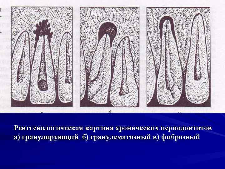 Рентгенологическая картина хронических периодонтитов а) гранулирующий б) гранулематозный в) фиброзный 