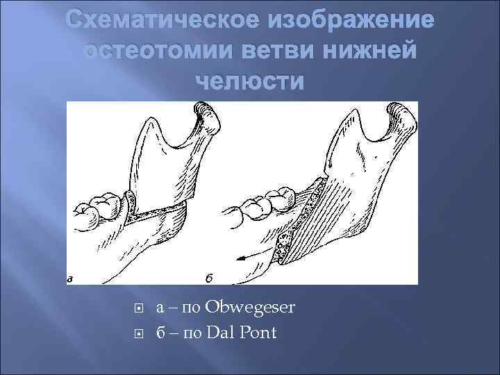 Схематическое изображение остеотомии ветви нижней челюсти а – по Obwegeser б – по Dal