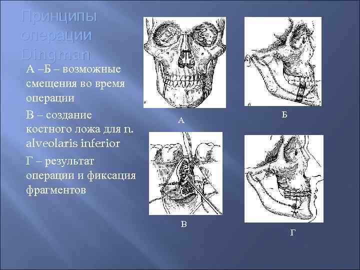 Принципы операции Dingman А –Б – возможные смещения во время операции В – создание