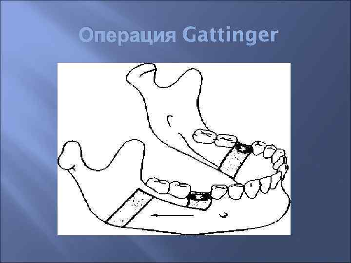 Операция Gattinger 