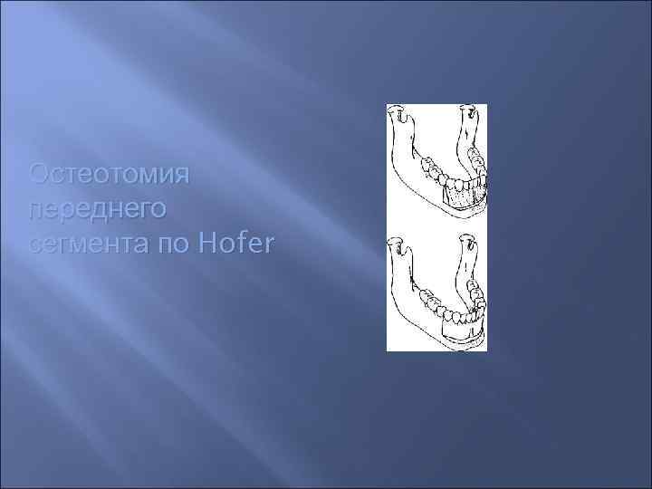 Остеотомия переднего сегмента по Hofer 