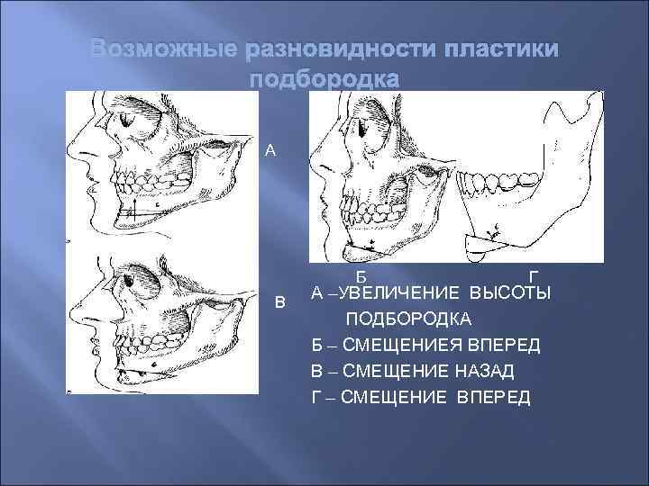 Возможные разновидности пластики подбородка А Б В Г А –УВЕЛИЧЕНИЕ ВЫСОТЫ ПОДБОРОДКА Б –