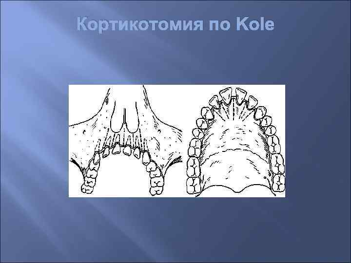 Кортикотомия по Kole 