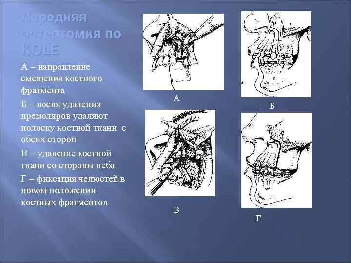 Передняя остеотомия по KOLE А – направление смещения костного фрагмента Б – посля удаления