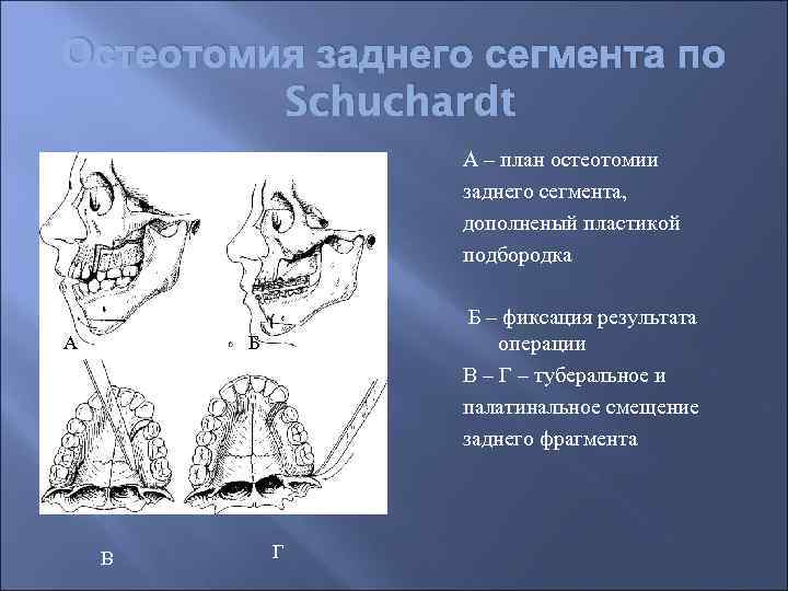 Остеотомия заднего сегмента по Schuchardt А – план остеотомии заднего сегмента, дополненый пластикой подбородка