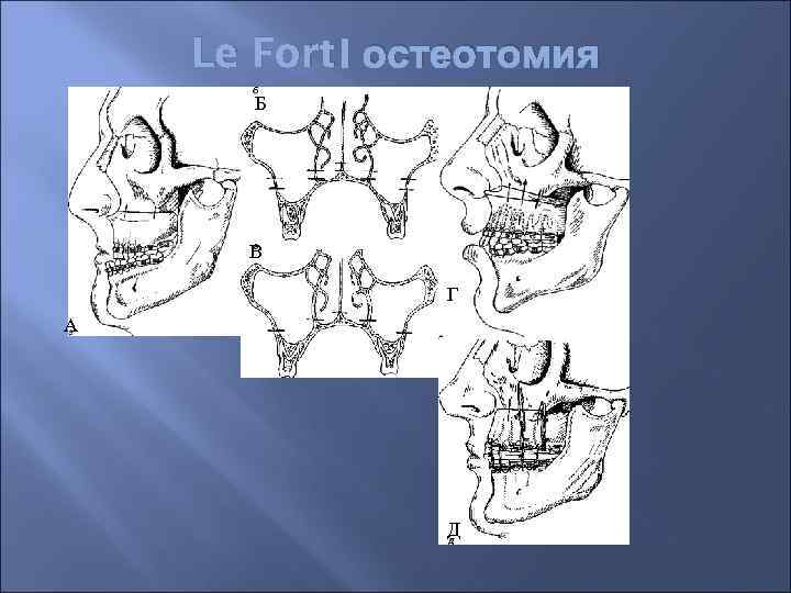 Le Fort І остеотомия Б В Le Fort I Г А Д 