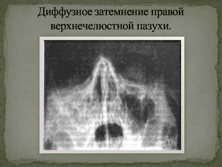Пристеночный отек слизистой. Затемнение гайморовых пазух на снимке что это. Субтотальное затемнение верхнечелюстных пазух рентген. Тотальное затемнение верхнечелюстной пазухи рентген. Пристеночный гайморит рентген.