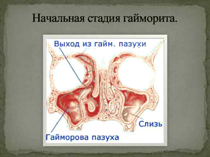 Начальная стадия гайморита. 