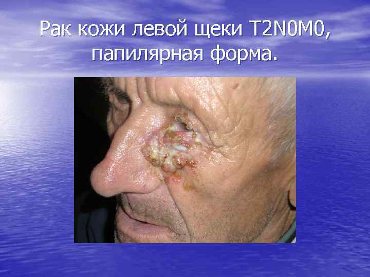 Рак кожи левой щеки Т 2 N 0 M 0, папилярная форма. 
