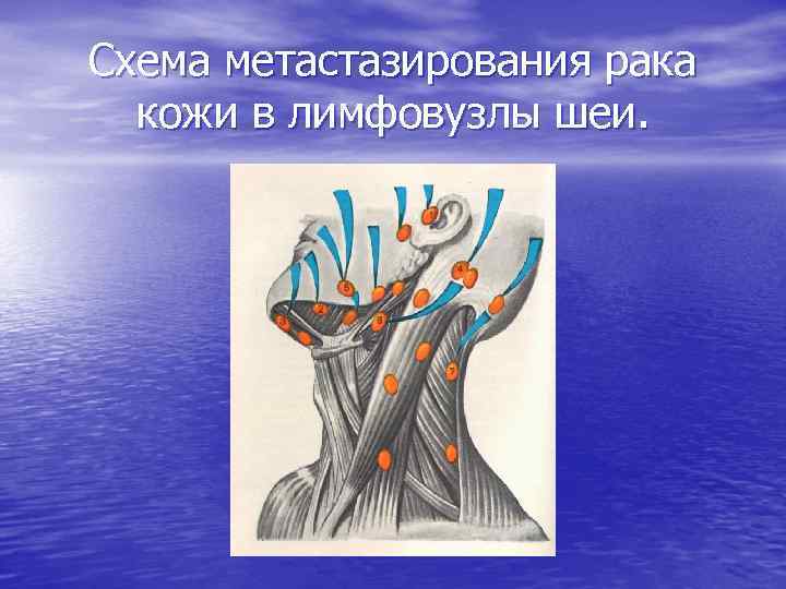 Схема метастазирования рака кожи в лимфовузлы шеи. 