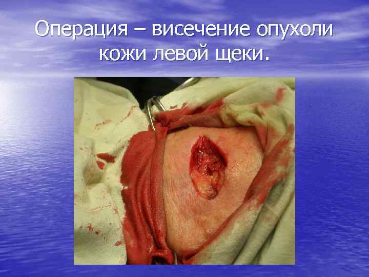 Операция – висечение опухоли кожи левой щеки. 