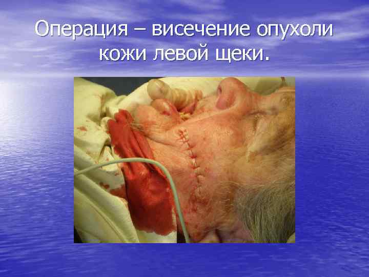 Операция – висечение опухоли кожи левой щеки. 