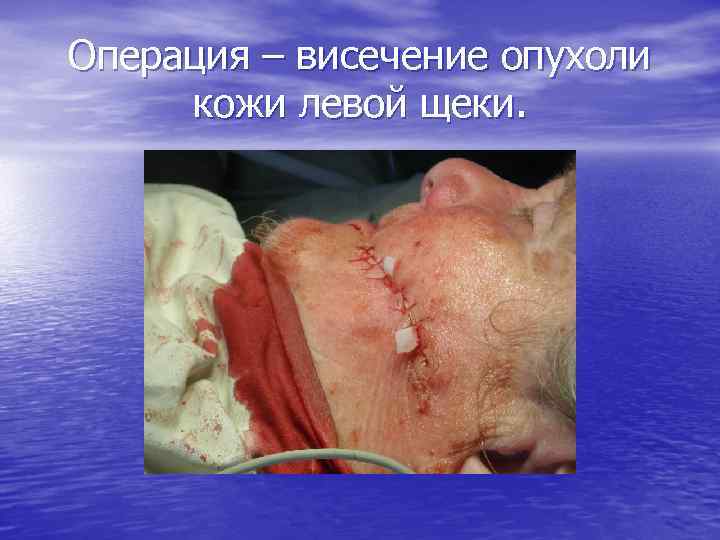 Операция – висечение опухоли кожи левой щеки. 