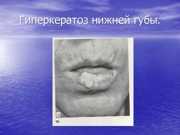 Гиперкератоз нижней губы. 