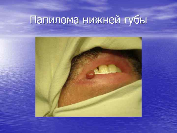 Папилома нижней губы 