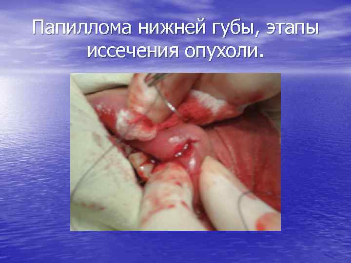 Папиллома нижней губы, этапы иссечения опухоли. 