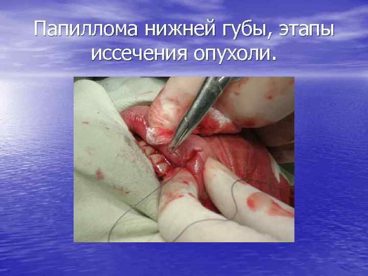 Папиллома нижней губы, этапы иссечения опухоли. 