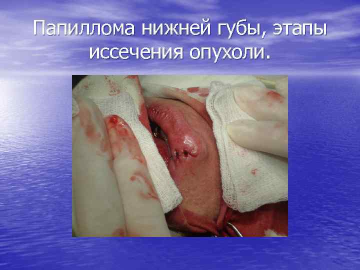 Папиллома нижней губы, этапы иссечения опухоли. 