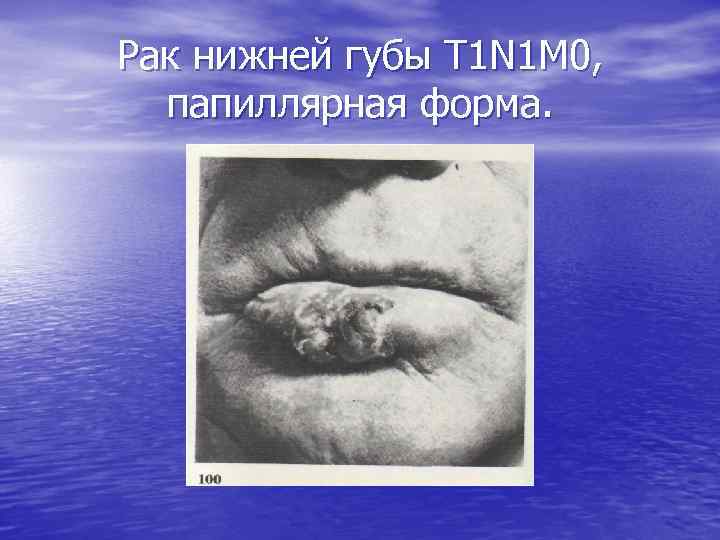 Рак нижней губы Т 1 N 1 M 0, папиллярная форма. 