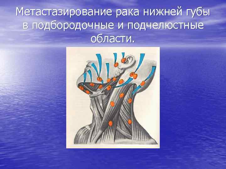 Метастазирование рака нижней губы в подбородочные и подчелюстные области. 